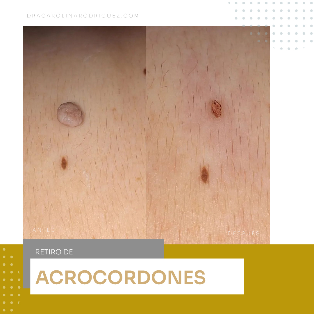 IMAGENES DRA ACROCORDONES-02