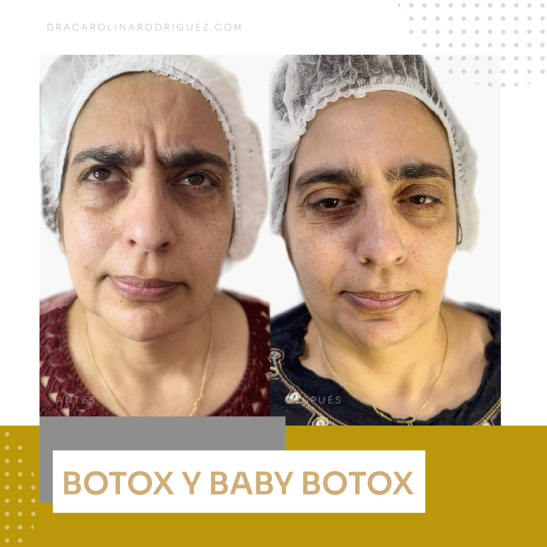 IMAGENES DRA botox-02