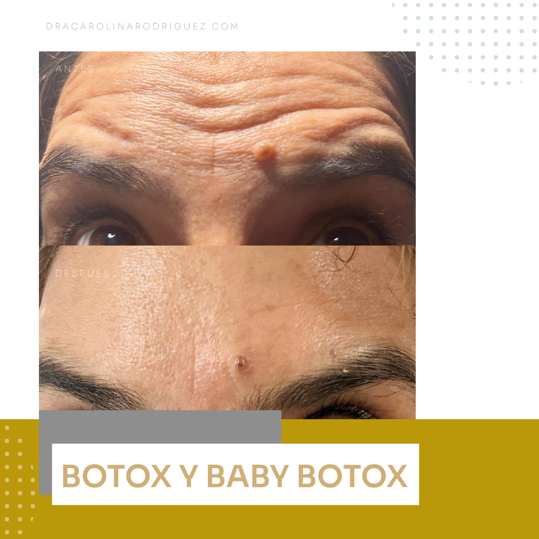 IMAGENES DRA botox_Mesa de trabajo 1